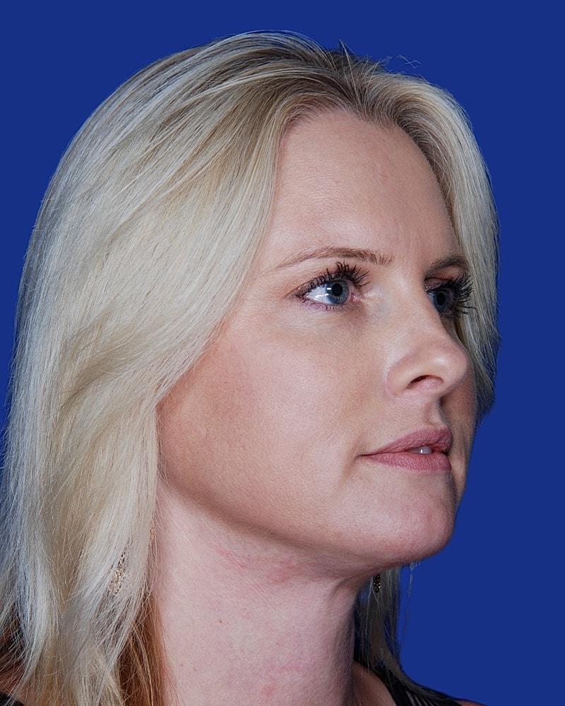 Facelift Before & After