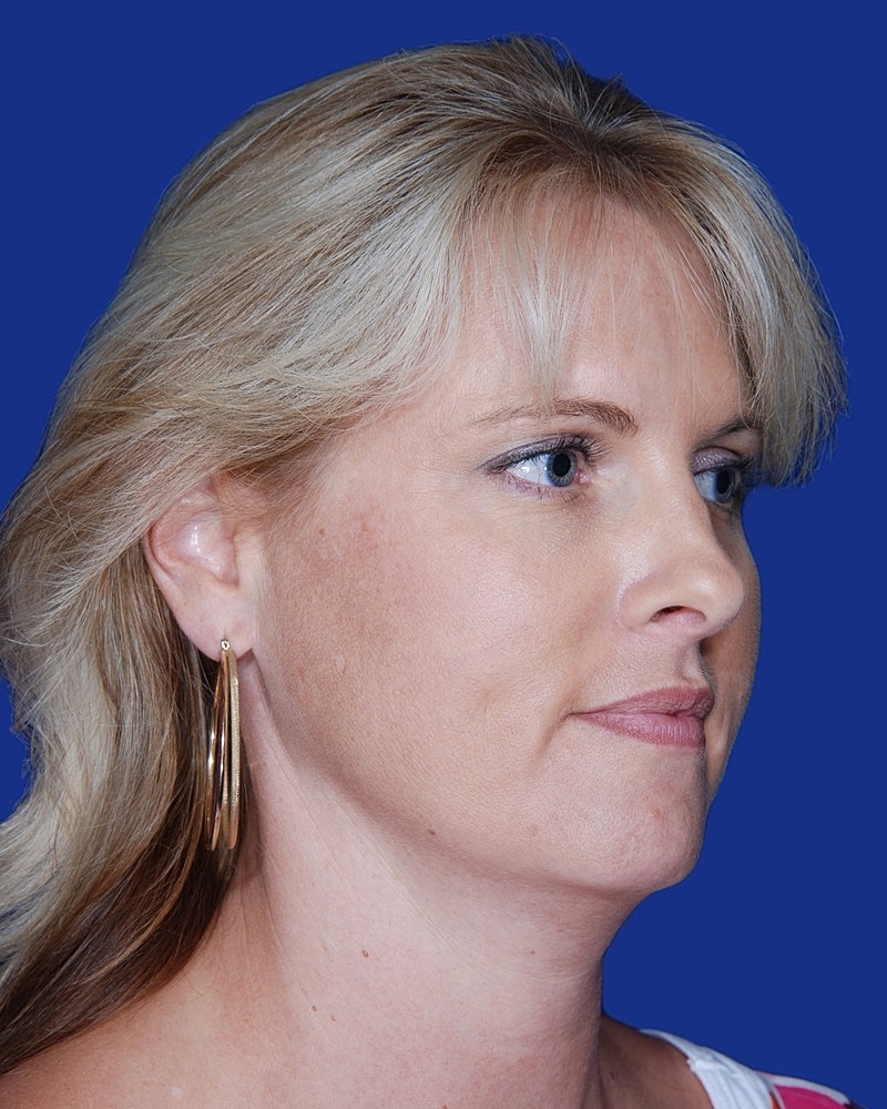 Facelift Before & After