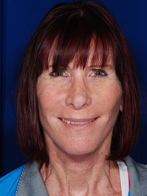Facelift Before & After