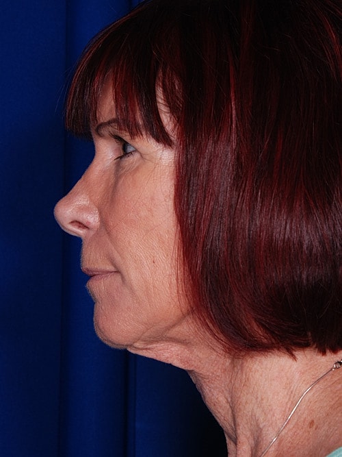 Facelift Before & After