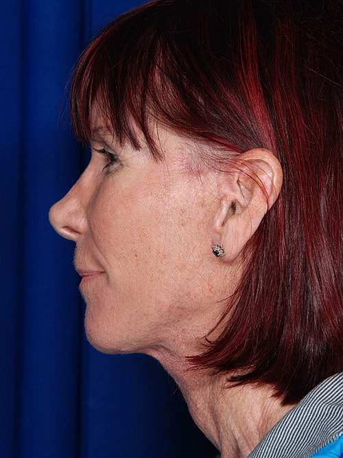 Facelift Before & After
