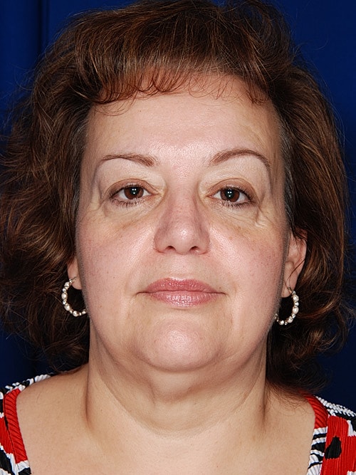 Facelift Before & After