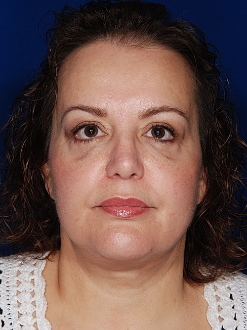 Facelift Before & After