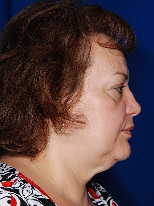 Facelift Before & After