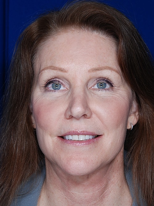 Facelift Before & After