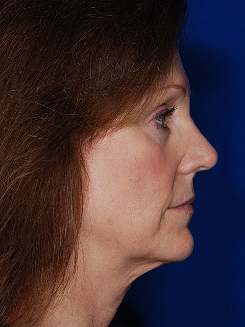 Facelift Before & After
