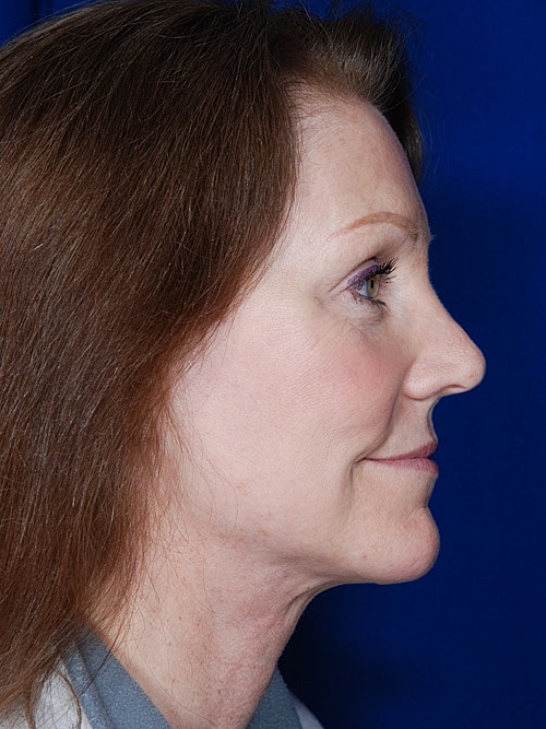 Facelift Before & After