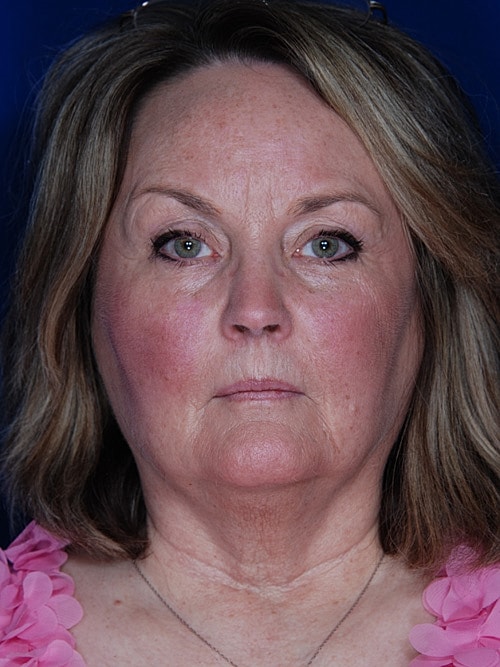 Facelift Before & After