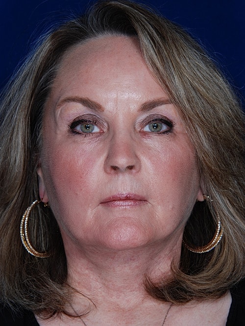 Facelift Before & After