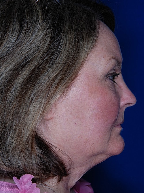 Facelift Before & After