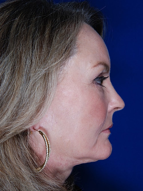 Facelift Before & After