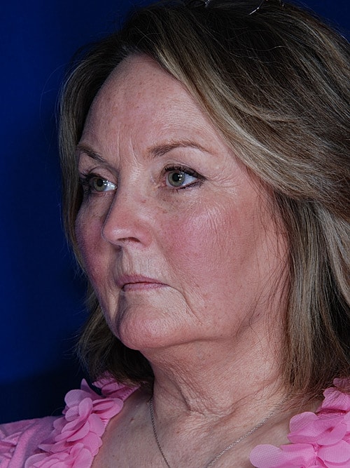 Facelift Before & After