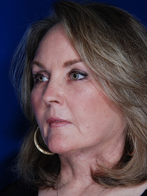 Facelift Before & After
