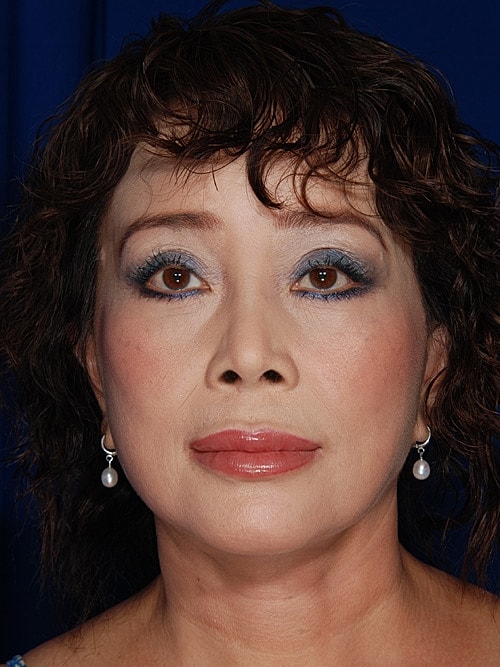 Facelift Before & After