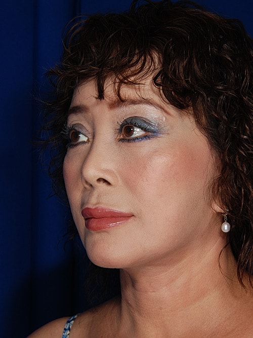 Facelift Before & After