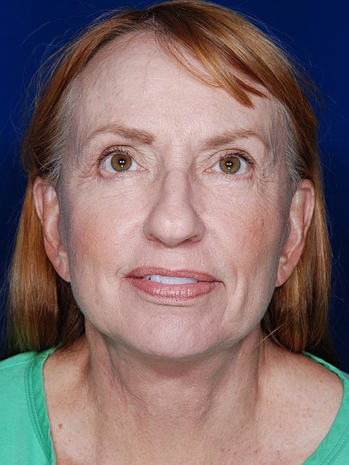 Facelift Before & After
