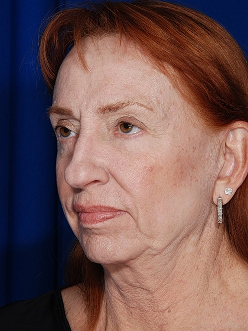 Facelift Before & After