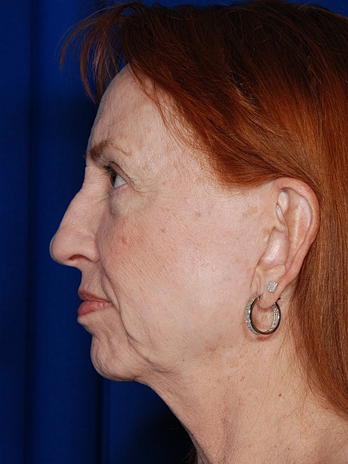 Facelift Before & After