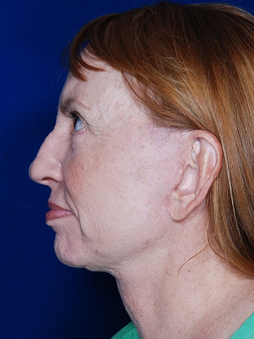 Facelift Before & After