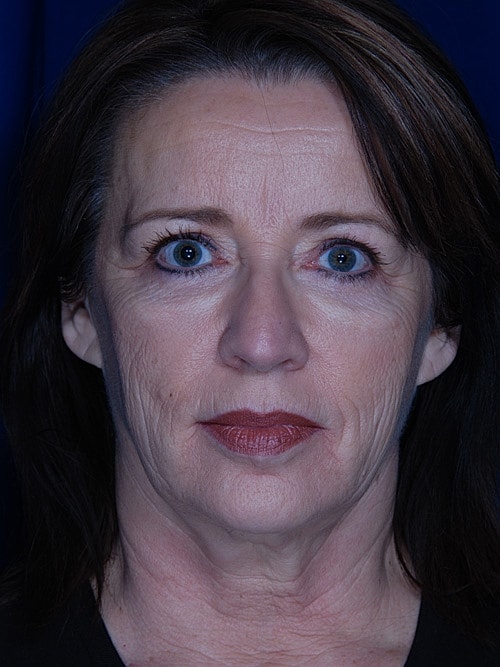 Facelift Before & After