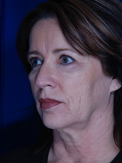 Facelift Before & After