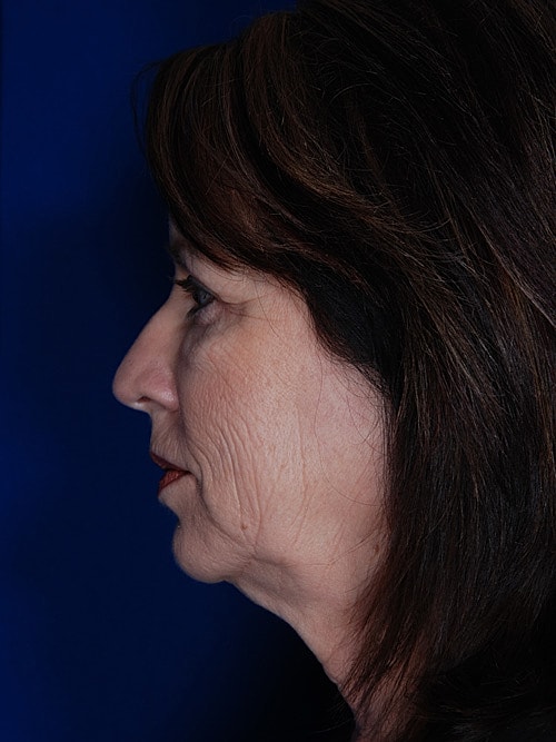 Facelift Before & After