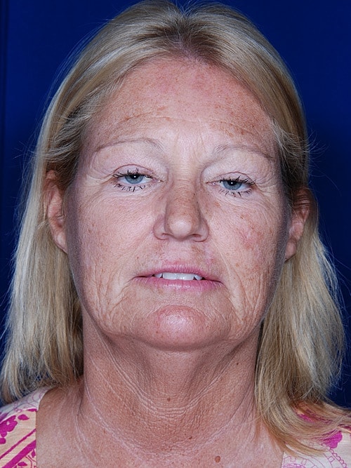 Facelift Before & After