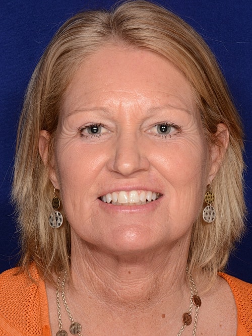 Facelift Before & After