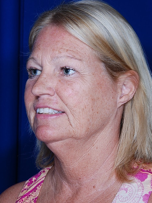 Facelift Before & After