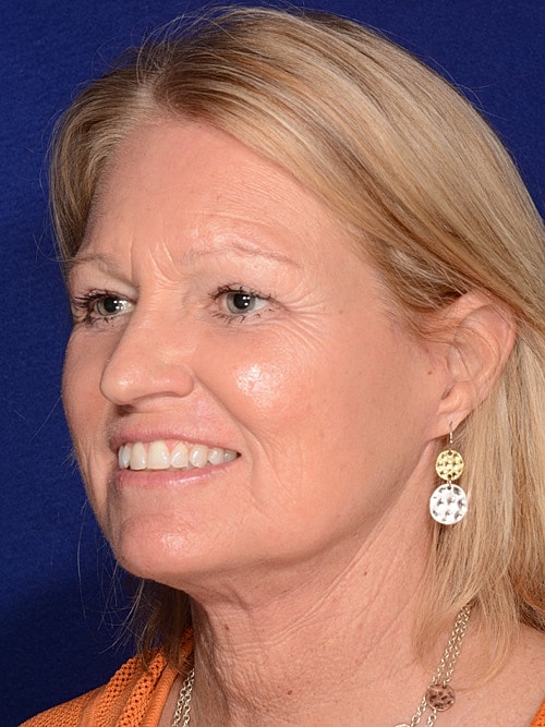 Facelift Before & After