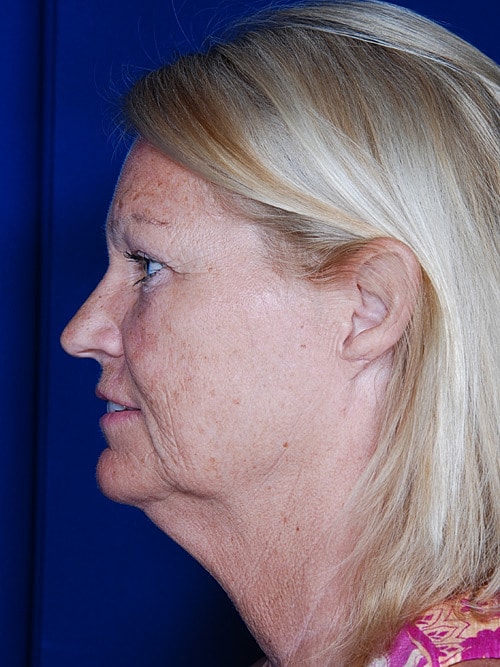 Facelift Before & After
