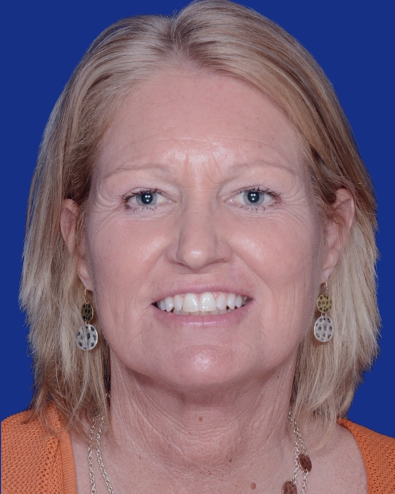 Facelift Before & After
