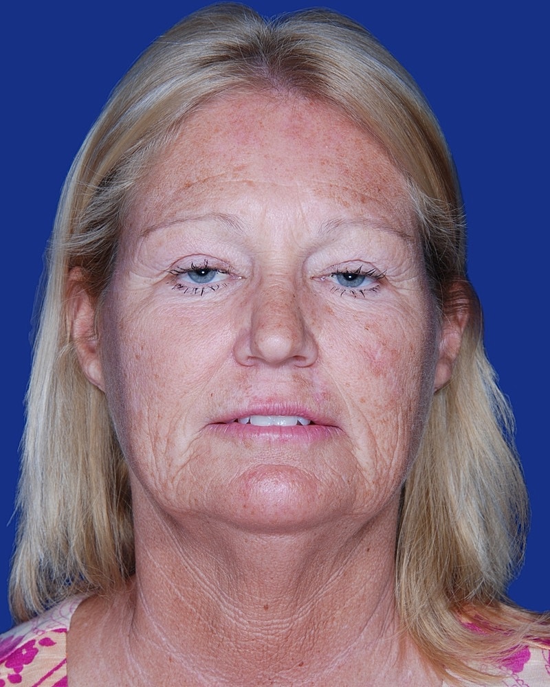 Facelift Before & After