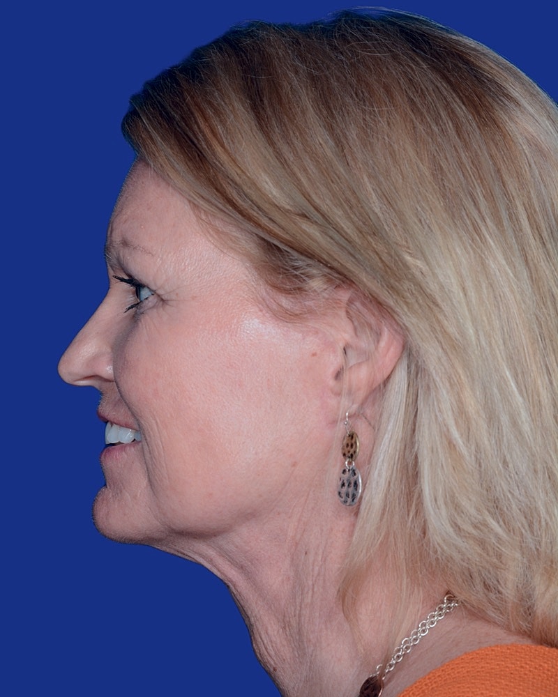 Facelift Before & After
