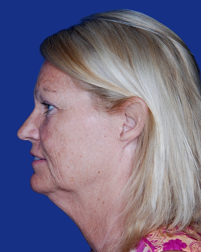 Facelift Before & After