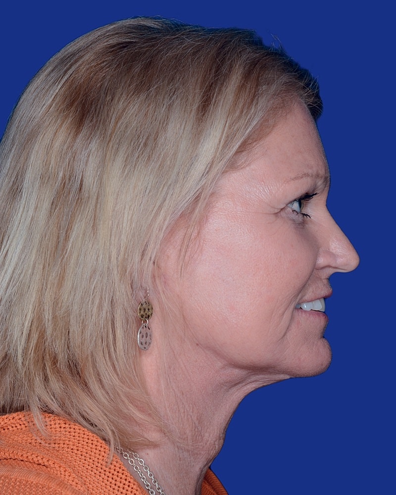 Facelift Before & After