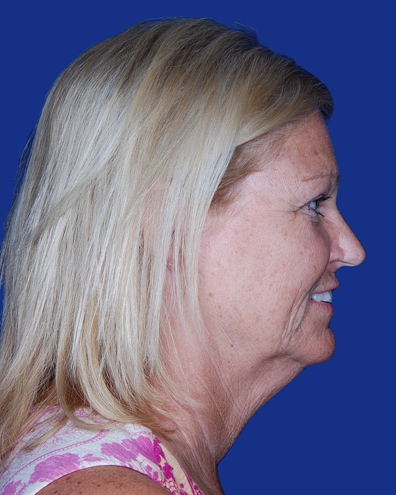 Facelift Before & After