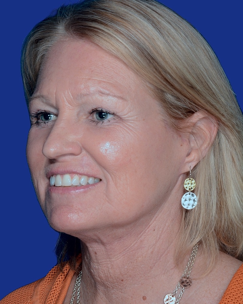 Facelift Before & After