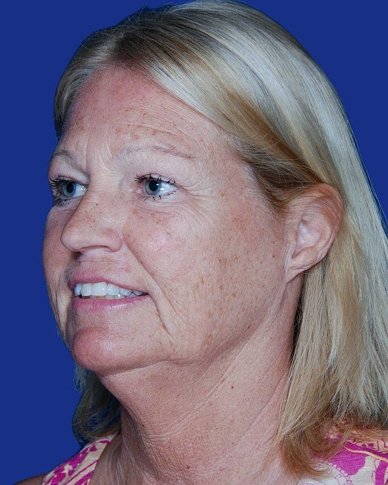 Facelift Before & After