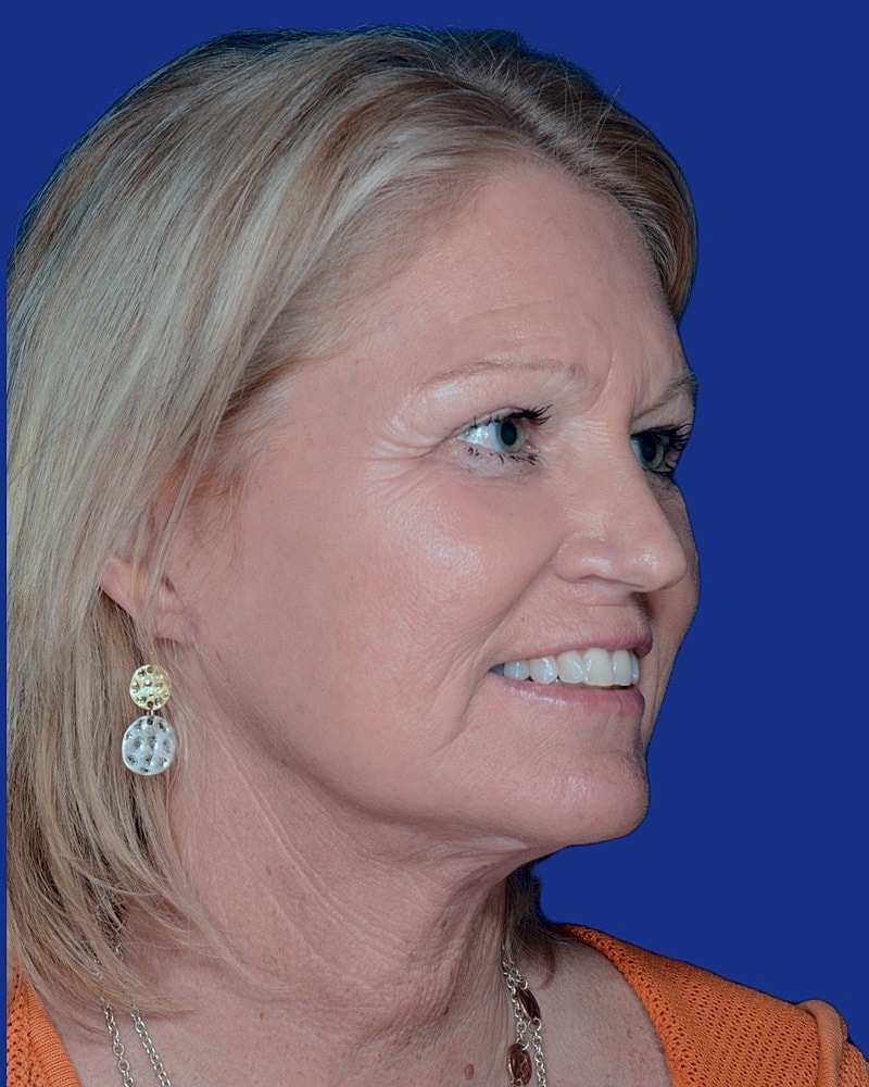 Facelift Before & After