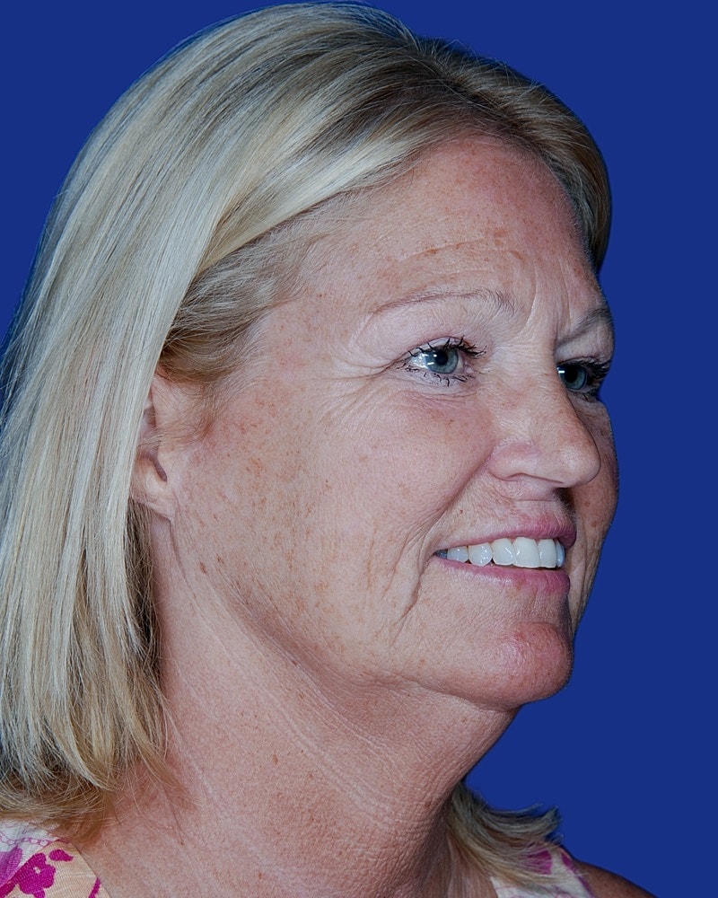 Facelift Before & After
