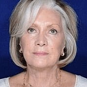 Facelift Before & After