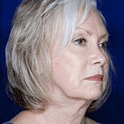 Facelift Before & After