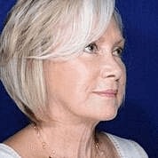 Facelift Before & After
