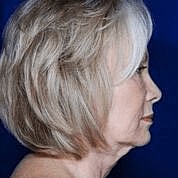 Facelift Before & After