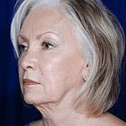 Facelift Before & After