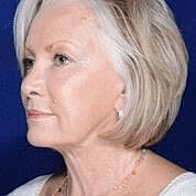 Facelift Before & After