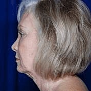 Facelift Before & After