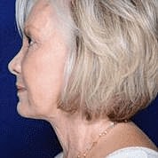Facelift Before & After