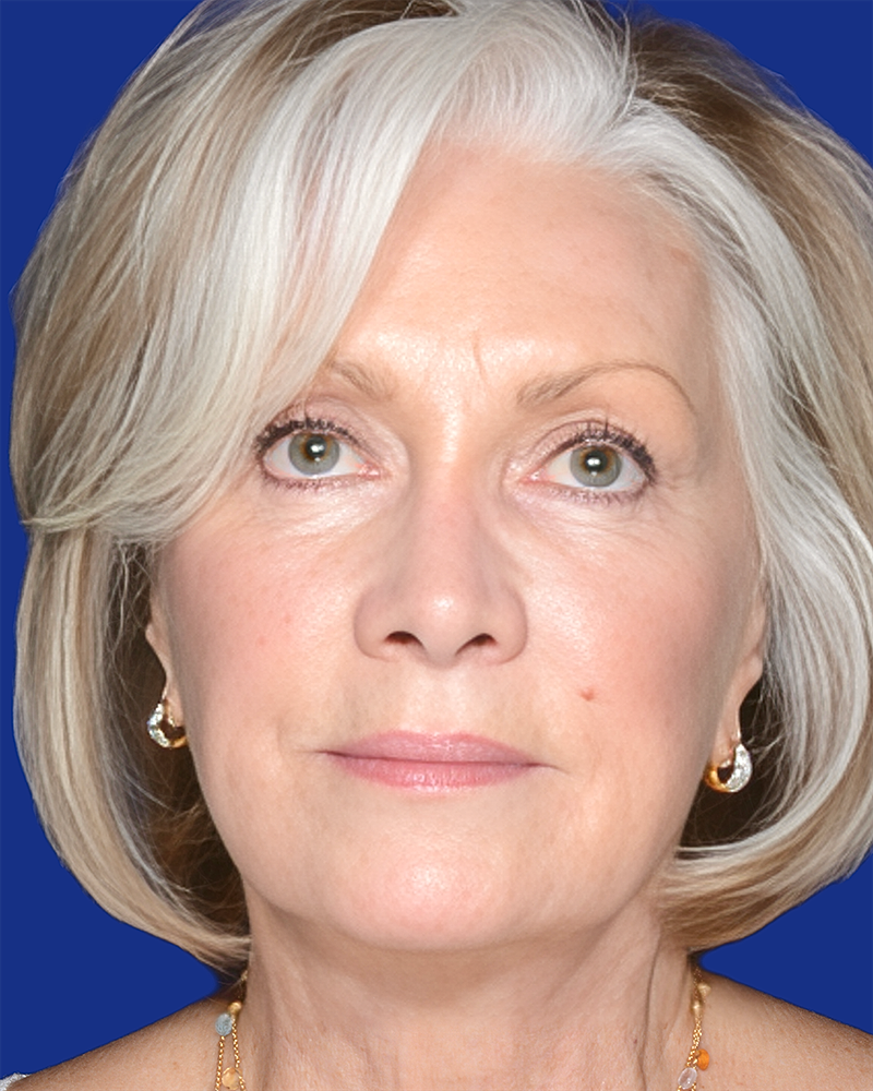Facelift Before & After